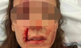 在Alkimos酒吧The Landing，一名年轻女子在戴上血淋淋的眼镜后幸运地保住了眼睛