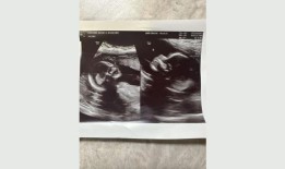 “百万分之一的机会”：阿拉巴马州一名双子宫妇女怀了两个孩子