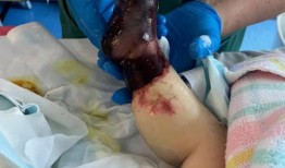 快乐健康的幼儿瑞安患上了一种常见的冬季臭虫摆在面前的是每个父母最可怕的噩梦