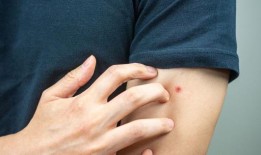 旅游专家揭示了一个简单的勺子技巧，可以立即阻止蚊子叮咬的瘙痒