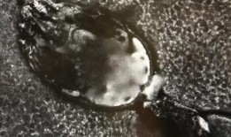 新南威尔士州四家医院爆发疥疮，38名患者感染