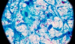 新的给药方法可用于靶向癌症、结核病