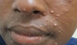 非洲正在努力应对又一起疑似麻疹病例