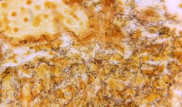 自1950年以来，美国从未见过如此高的梅毒病例